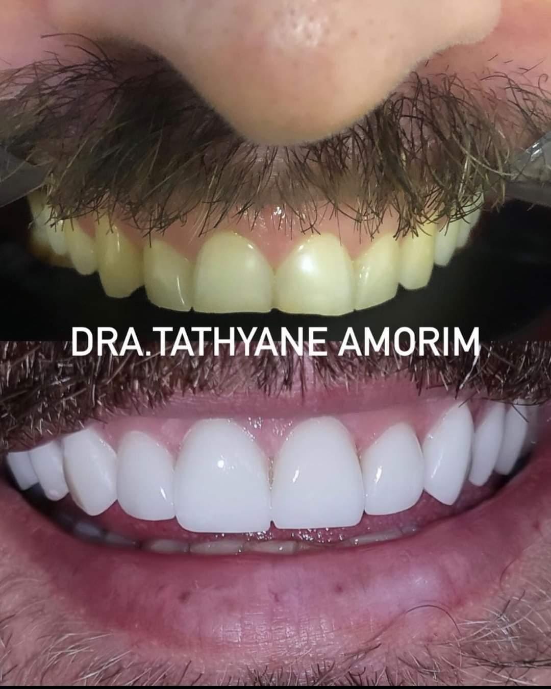 Lentes de contato dental — antes e depois