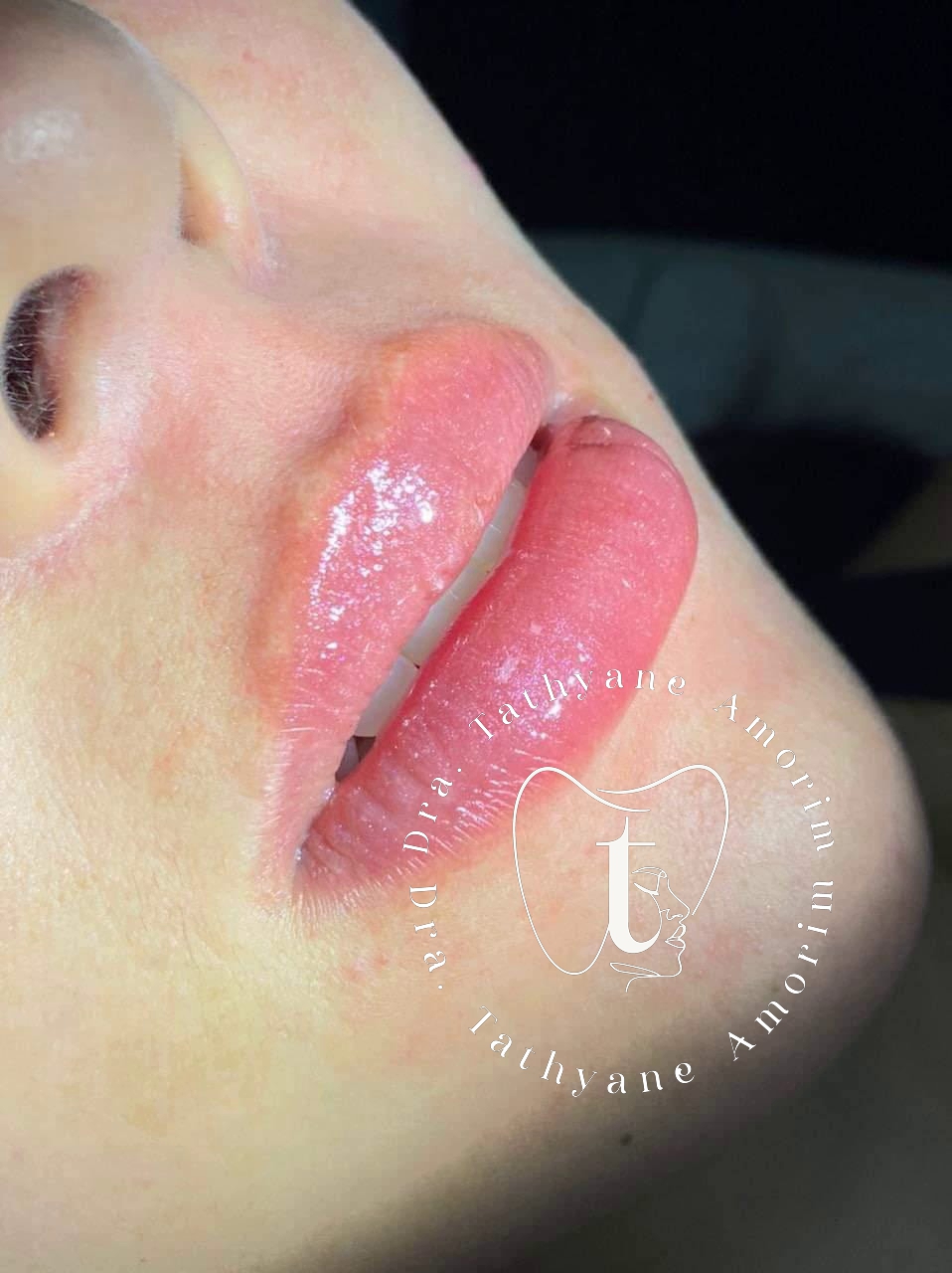 Harmonização orofacial — preenchimento labial