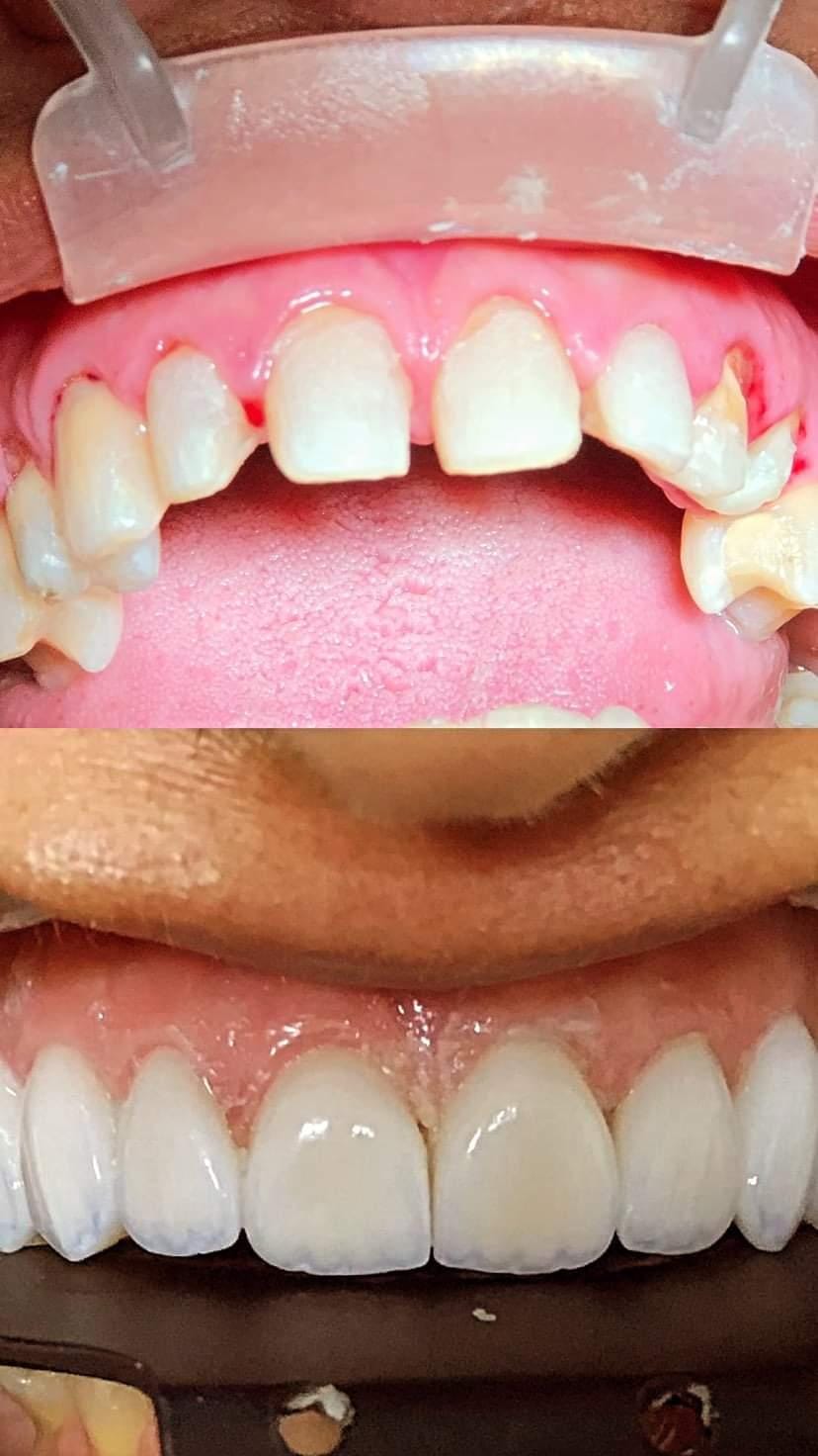 Reabilitação com facetas em porcelana